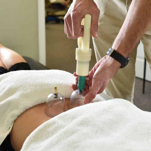 vacuum-cupping-anatomix-physical-therapy-Hammond-Mandeville-LA